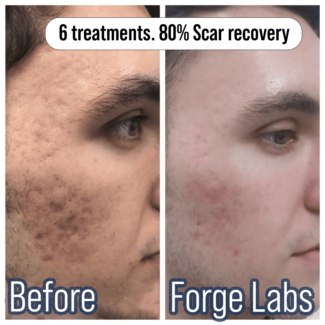 Microneedling Scar recovery