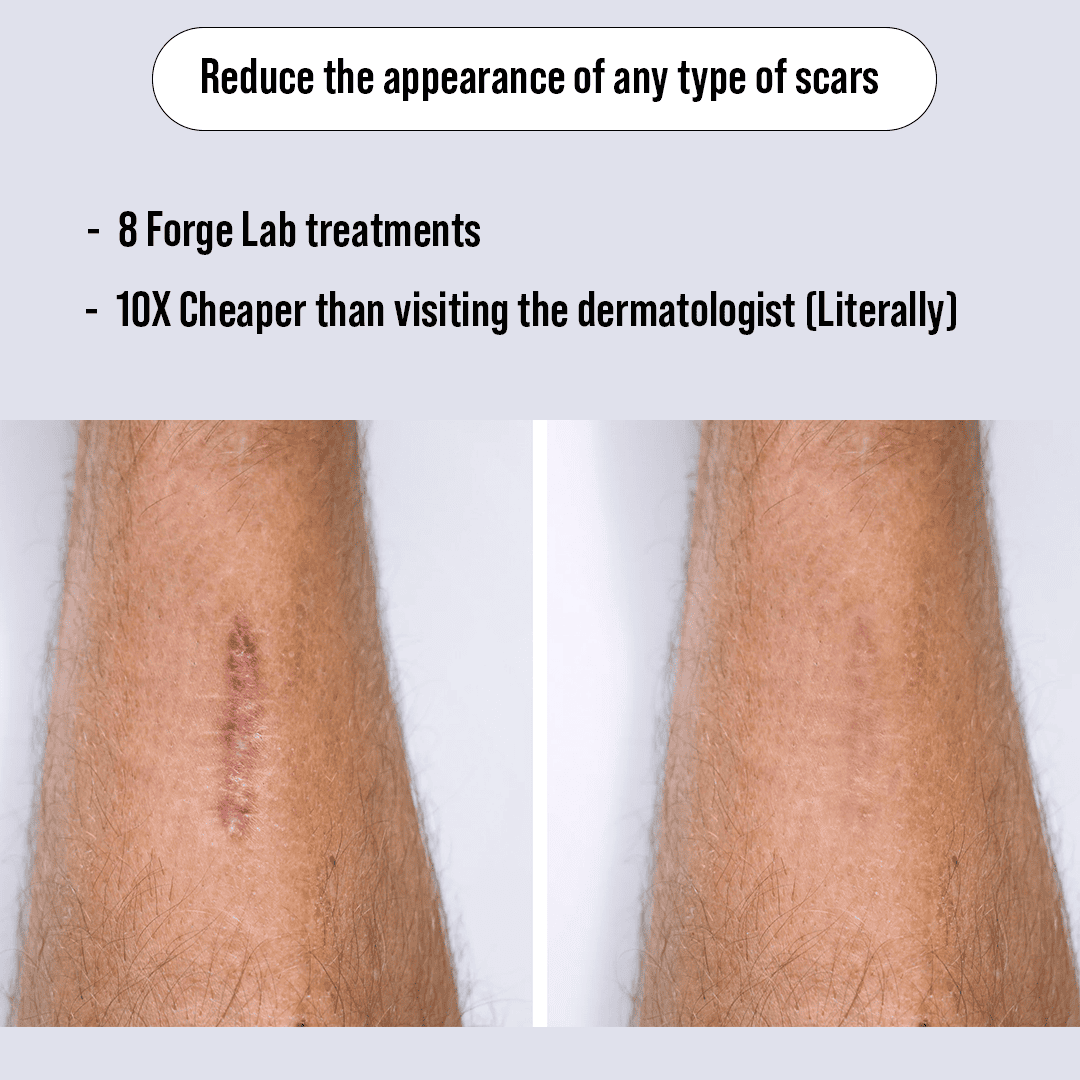 Microneedling Scar recovery