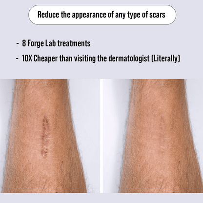 Microneedling Scar recovery