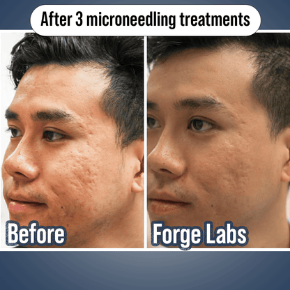 Microneedling Scar recovery