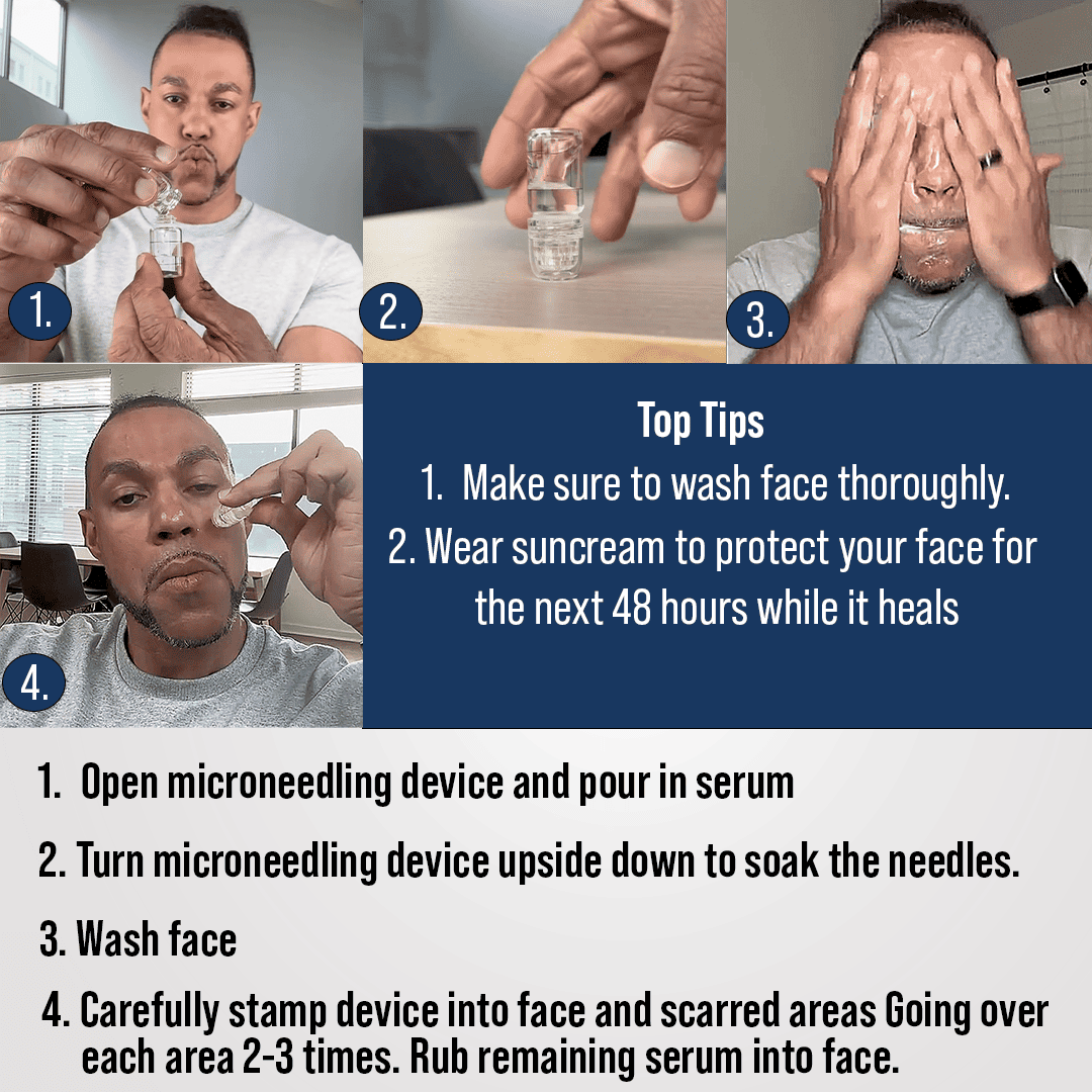 Microneedling Scar recovery