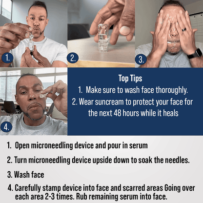 Microneedling Scar recovery